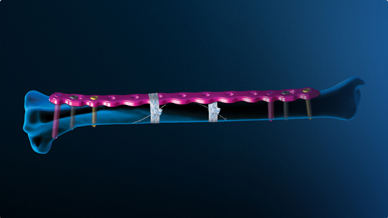 Anatomic representation of a small animal bone with a metal plate attached, surrounded by a blue aura.